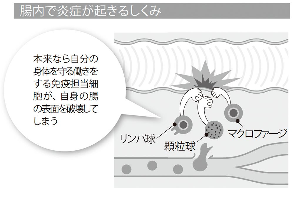 画像・写真｜【名医に聞く 潰瘍性大腸炎】免疫異常が大腸に限って起き、原因は不明。予防ができない病気なので、病気とうまく付き合って 女性の病気 ...